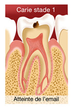 Caries et soins des caries - Illustration 1