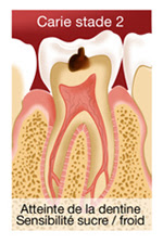 Caries et soins des caries - Illustration 2