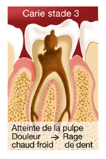 Caries et soins des caries - Illustration 3
