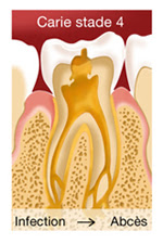 Caries et soins des caries - Illustration 4
