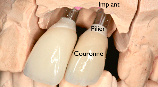 Les Implants - Illustration 8