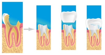 Les Protheses - Illustration 1